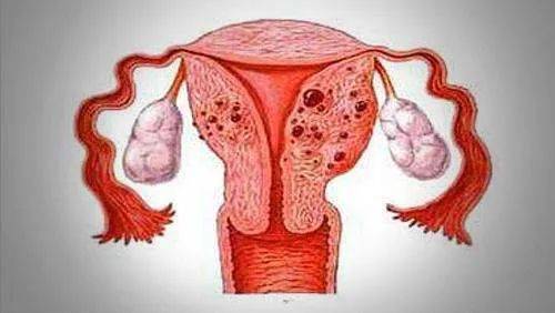 子宫腺肌症和子宫肌瘤的症状一样吗？