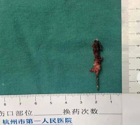 17岁小伙参军体检发现胸腔内有根5cm缝衣针，父母回忆或是1岁时扎入，取出时已锈迹斑斑